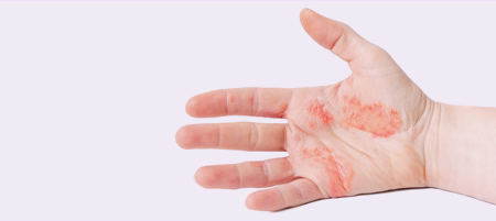 Dyshidrotic eczema